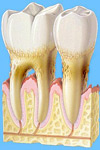advanced_periodontitis.jpg