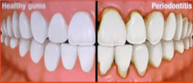  periodontitis.jpg